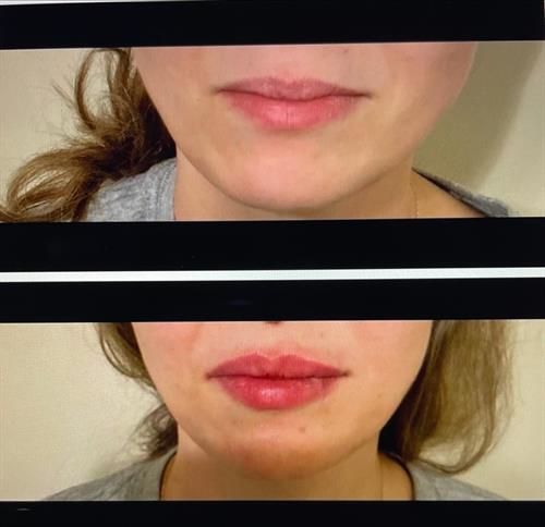 before and after fillers