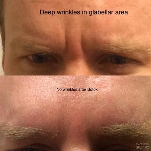 Gallery Image botox_treatment_of_deep_wrinkles_between_eyes_at_VIVAA.jpg
