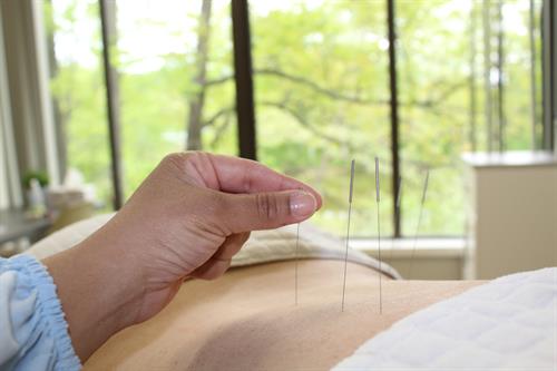 Acupuncture for Pain and Botox for Migraines, Cervical Dystonia and Spasticity