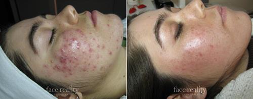 Gallery Image acne-facial-treatment-program-teen-adult-facereality-shelton-wa.jpg Gallery Image acne-facial-treatment-program-teen-adult-facereality-shelton-wa.jpg