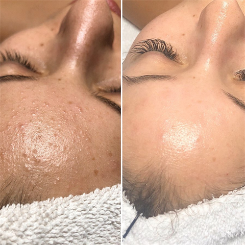 Gallery Image peels-acne.png