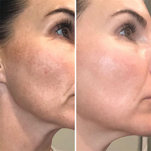 Gallery Image peels_pigmentation.png