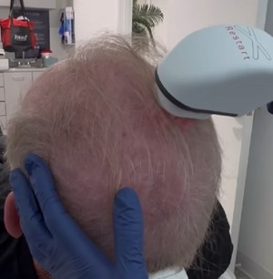 HAIRestart®Treatment for Alopecia (hair loss) using the FOTONA X-Restart Laser Hand Piece which uses non-ablative, precisely engineered laser pulses that unlike other lasers, do not damage the existing hair. We can supplement the treatment with Platelet Rich Plasma (PRP) and Polydioxanone (PDO) threads to maximize results. 