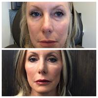 Fillers - before and after