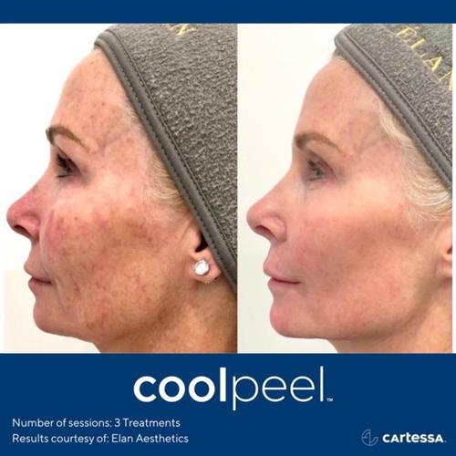 CoolPeel CO2 laser treatment