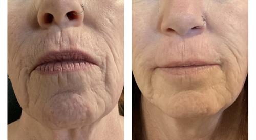 Before and After Morpheus8 RF Microneedling treatments x3