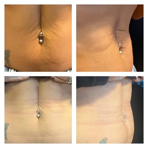 Body Contouring with TruScupt ID and Trusculpt Flex