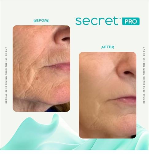 Secret RadioFrequency and  MicroNeedling treatment 