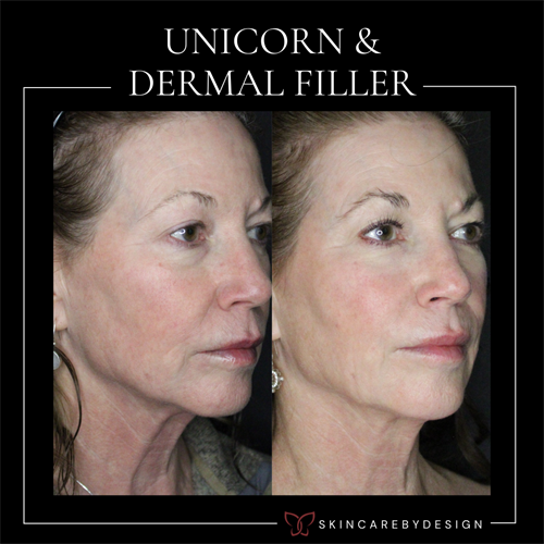 Gallery Image UNicorn_and_Dermal_filler_(3).png