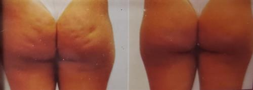 Cellulite Treatment Before and After