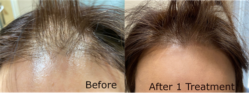 Women's Hair Loss Treatment