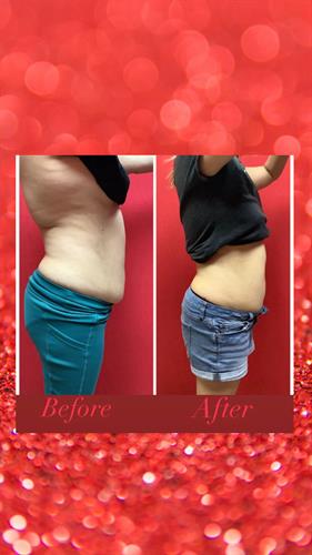 Fat Reduction Treatment Before and After