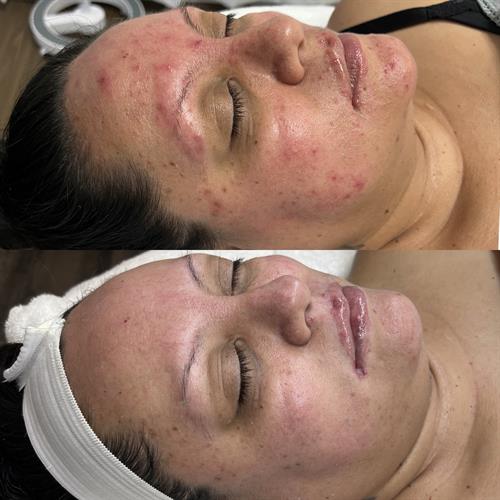 DMK Acne Treatment 