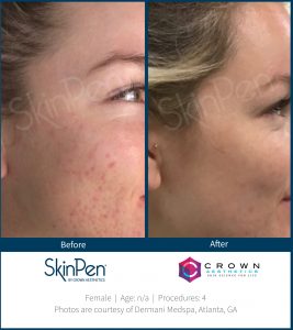 Micro-Needling Before & After