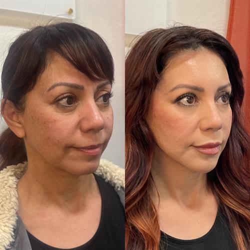 Lower Face Revamp (3 syringes of Restylane in the lower face)