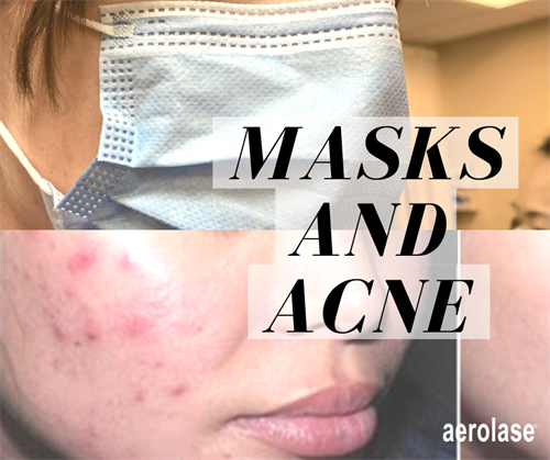 Acne Laser Treatment