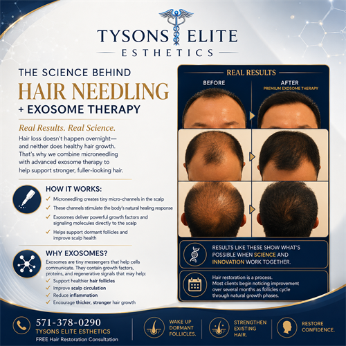 Hair needling with Exosome