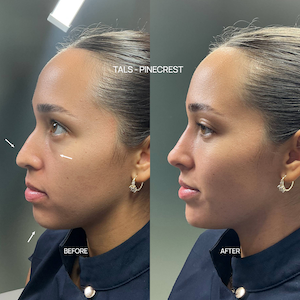 Facial balancing Before / After