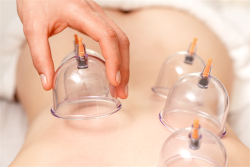 Cupping Therapy