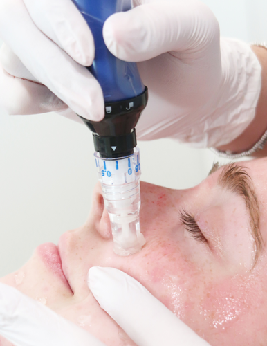 Gallery Image SKINriched%20microneedling.png