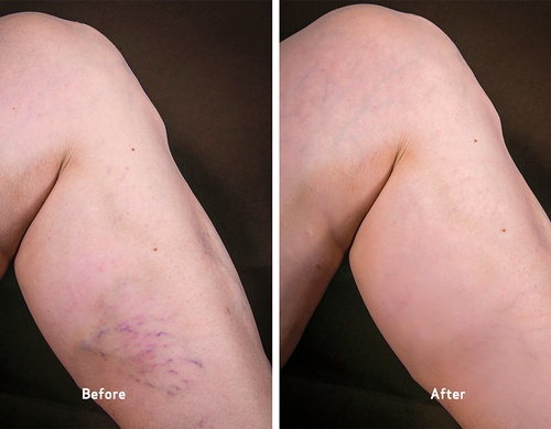 Gallery Image vca-before-and-after-sclerotherapy.jpg