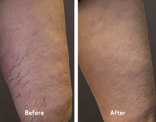 Gallery Image vca-before-and-after-spider-veins.jpg
