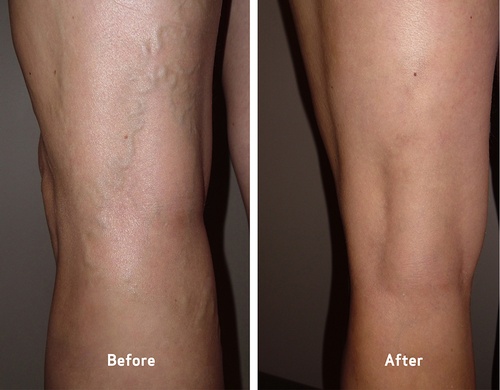 Gallery Image vca-before-and-after-varicose-veins-pain.jpg