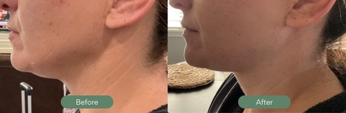 Gallery Image BA-Kybella-2.jpg