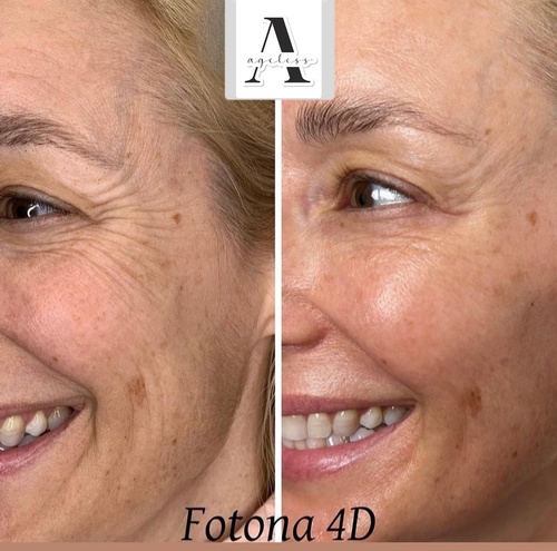 Gallery Image Ageless%20Fotona%204D%20Before%20and%20After.jpg