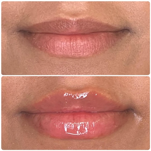 Gallery Image Ageless%20Lip%20Filler%20Before%20and%20After.jpg