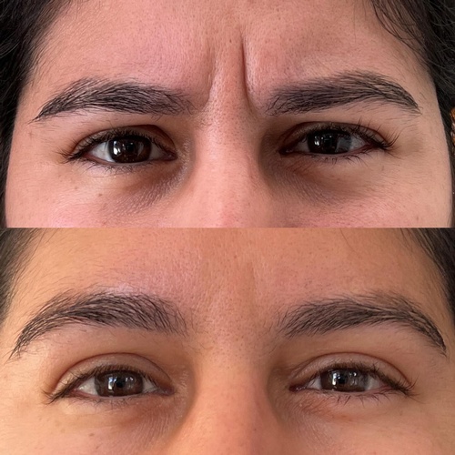 Gallery Image Ageless%20Tox%20Treatment%20Before%20and%20After.jpg