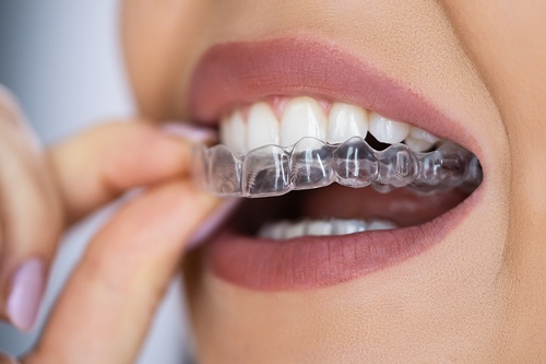 Gallery Image bigstock-Clear-Aligner-Dental-Night-Gua-463488851.jpg